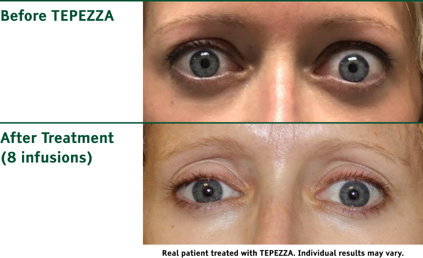 Comparison photos of patient with Chronic Thyroid Eye Disease before and after TEPEZZA treatment, with post-treatment photo showing less eyelid retraction after 8 infusions
