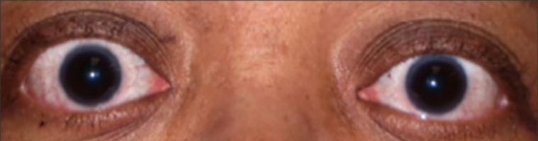 Front view of eyes after TEPEZZA treatment (Week 24)