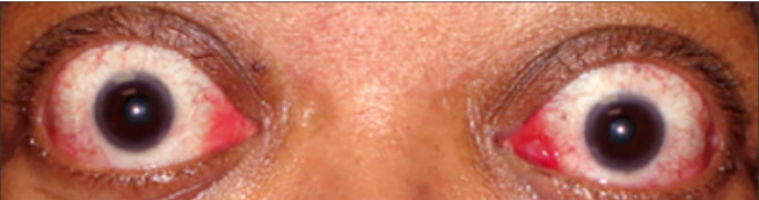 Front view of proptosis before treatment
