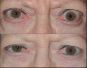 Thyroid Eye Disease photos showing a patient who has had TED for years at baseline and at Week 24 following TEPEZZA treatment, frontal view.