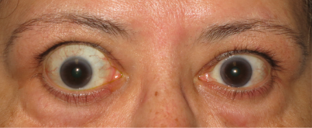 Baseline exophthalmos front view