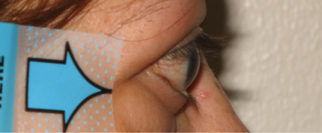 Baseline exophthalmos side view