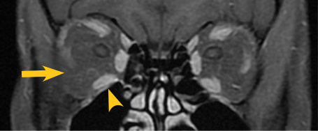 Post-treatment with TEPEZZA proptosis MRI scan