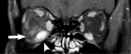 Baseline proptosis MRI scan