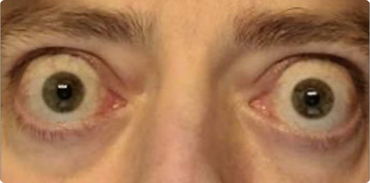 Bulging eyes front
