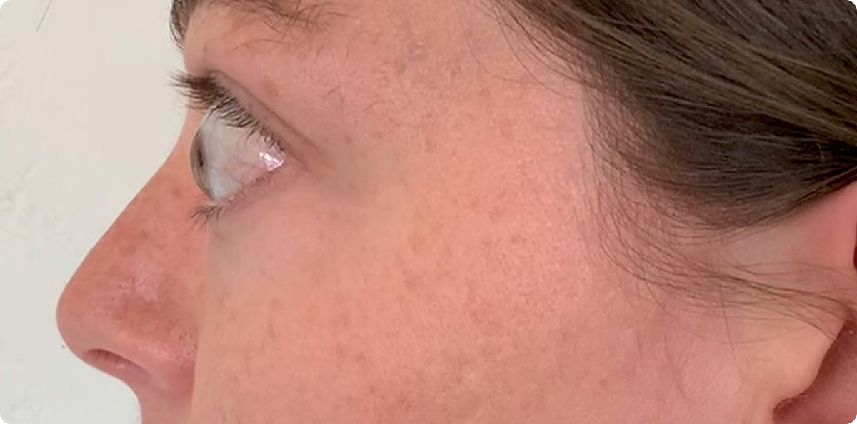Bulging eyes side