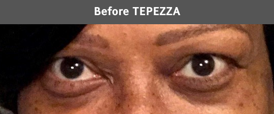 before-tpz