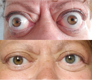 Comparison photos of patient with Thyroid Eye Disease before and after TEPEZZA treatment, with post-treatment photo showing reduced eye bulging after 8 infusions