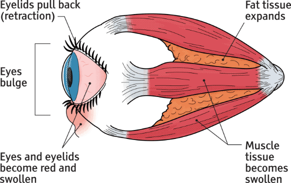 Diagram of the eye during periods of high inflammation from Thyroid Eye Disease
