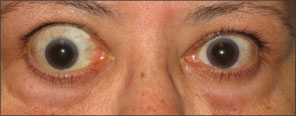 Front view of bulging eyes after TEPEZZA treatment