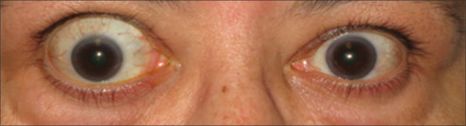 Front view of bulging eyes after TEPEZZA treatment
