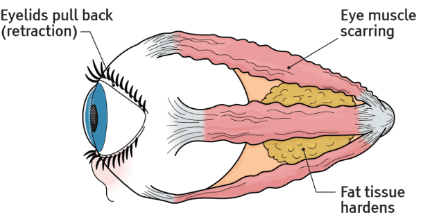Diagram of the eye with long-term damage from Thyroid Eye Disease