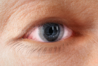 Double vision from Thyroid Eye Disease