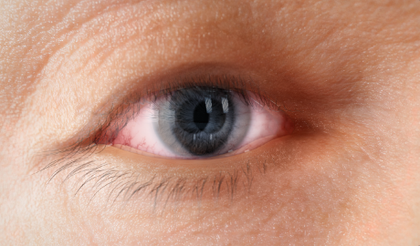 Double vision from Thyroid Eye Disease
