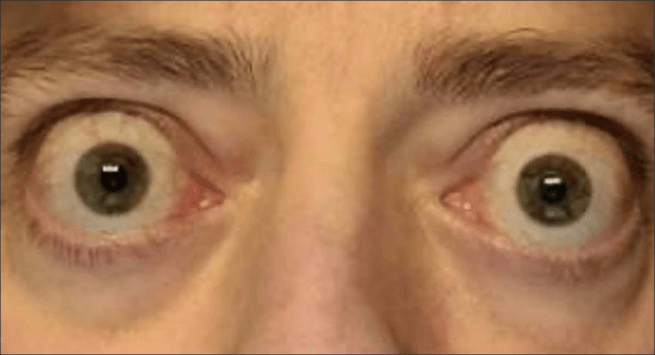 Front view of bulging eyes protruding from the eye socket as a result of Thyroid Eye Disease before TEPEZZA