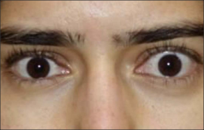 Front view of a woman's bulging eyes protruding from the eye socket as a result of Thyroid Eye Disease before TEPEZZA