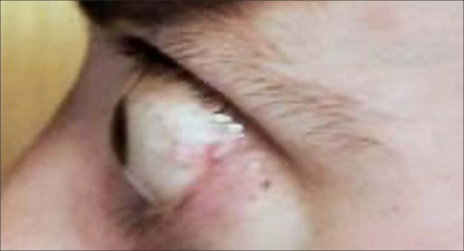 Side view of bulging eyes protruding from the eye socket as a result of Thyroid Eye Disease before TEPEZZA