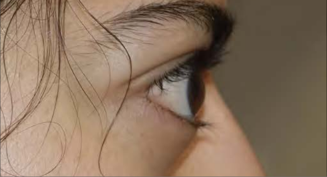 Side view of a woman's bulging eyes protruding from the eye socket as a result of Thyroid Eye Disease before TEPEZZA