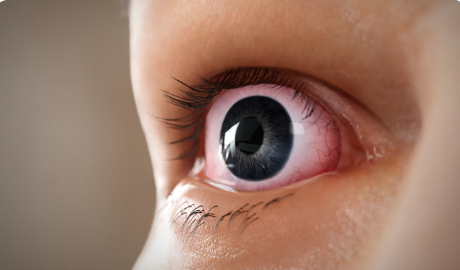 Eyelid retraction from Thyroid Eye Disease