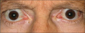 Front view of protruding eyes after TEPEZZA treatment (Week 24)