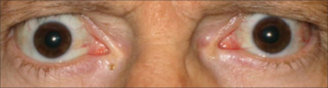 Front view of protruding eyes after TEPEZZA treatment (Week 24)