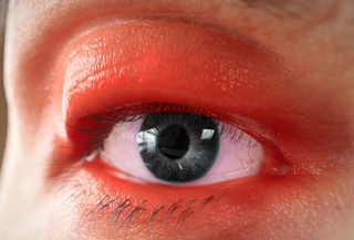 Red and swollen eyes from Thyroid Eye Disease