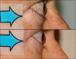 Side view of patient before and after thyroid eye disease treatment with TEPEZZA, with visually apparent decrease in protruding eyes at Week 24