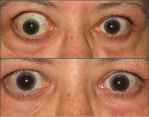 Front view of patient before and after thyroid eye disease treatment with TEPEZZA, with visually apparent decrease in eye bulging at Week 24