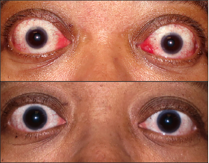 Front view of patient before and after thyroid eye disease treatment with TEPEZZA, with visually apparent decrease in proptosis at Week 24