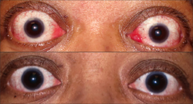Front view of patient before and after thyroid eye disease treatment with TEPEZZA, with visually apparent decrease in proptosis at Week 24