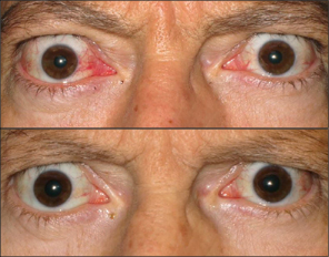 Front view of patient before and after thyroid eye disease treatment with TEPEZZA, with visually apparent decrease in protruding eyes at Week 24