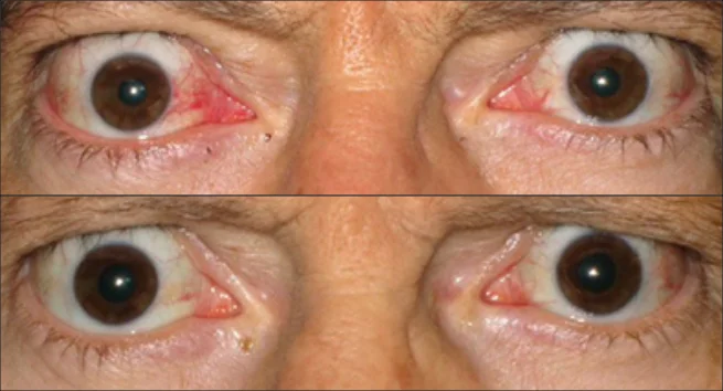 Thyroid Eye Disease photos of male patient at baseline and Week 24 of TEPEZZA treatment, front view of protruding eyes