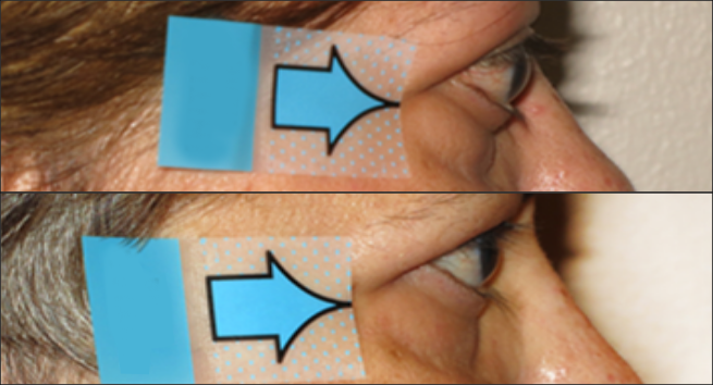 Side view of patient before and after thyroid eye disease treatment with TEPEZZA, with visually apparent decrease in eye bulging at Week 24
