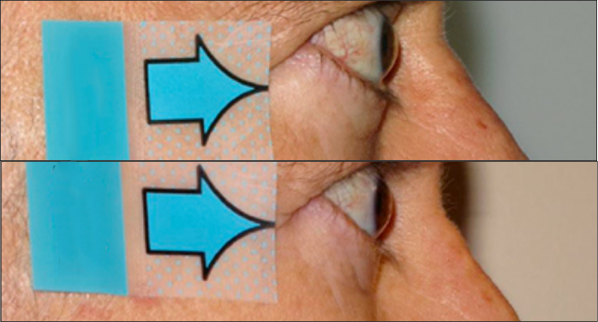 Side view of patient before and after thyroid eye disease treatment with TEPEZZA, with visually apparent decrease in protruding eyes at Week 24