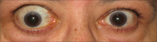 Vista frontal de ojos abultados antes del tratamiento con TEPEZZA