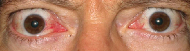 Vista frontal de ojos saltones antes del tratamiento