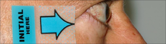 Side view of protruding eyes before treatment