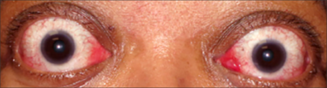 Vista frontal de la exoftalmia antes del tratamiento