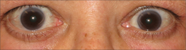 Vista frontal de los ojos después del tratamiento con TEPEZZA