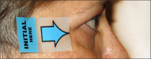 Vista lateral de los ojos después del tratamiento con TEPEZZA