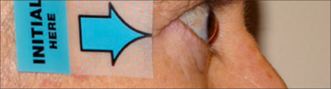Vista lateral de los ojos después del tratamiento con TEPEZZA