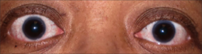 Vista frontal de la exoftalmia después del tratamiento con TEPEZZA