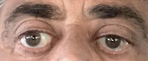 Chronic Thyroid Eye Disease patient after eight TEPEZZA infusions