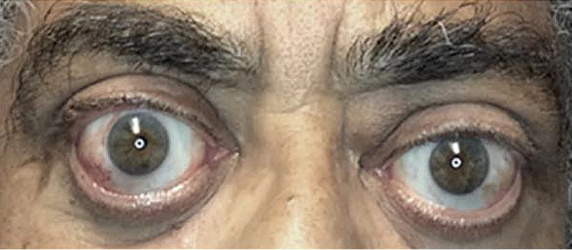 Chronic Thyroid Eye Disease patient before TEPEZZA with eye bulging, double vision, mild redness, swelling, and pain