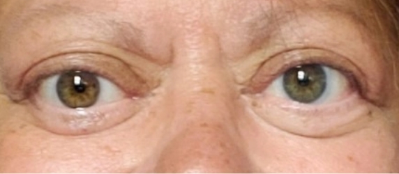 Chronic Thyroid Eye Disease patient after eight TEPEZZA infusions