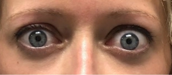 Chronic Thyroid Eye Disease patient with bulging eyes before first TEPEZZA infusion