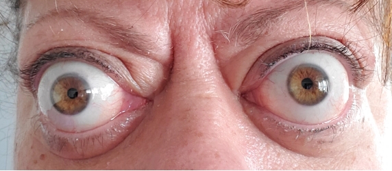 Chronic Thyroid Eye Disease patient with bulging eyes before starting TEPEZZA