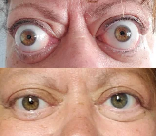 Photos of patient with Chronic Thyroid Eye Disease before and after TEPEZZA treatment, with post-treatment photo showing reduced eye bulging after 8 infusions