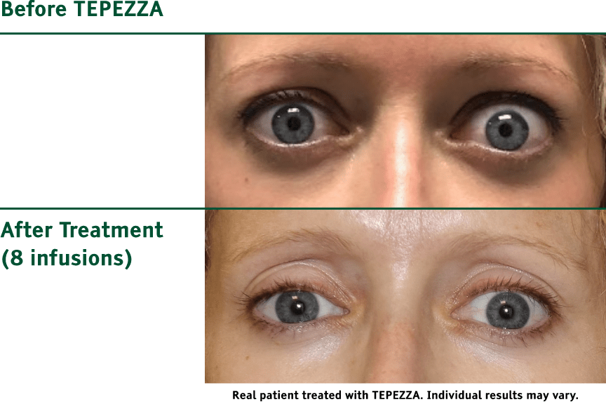 Comparison photos of patient with Chronic Thyroid Eye Disease before and after TEPEZZA treatment, with post-treatment photo showing less eyelid retraction after 8 infusions