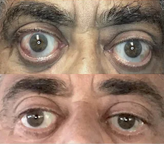 Comparison photos of patient with Thyroid Eye Disease before and after TEPEZZA treatment, with post-treatment photo showing reduced eye bulging after 8 infusions